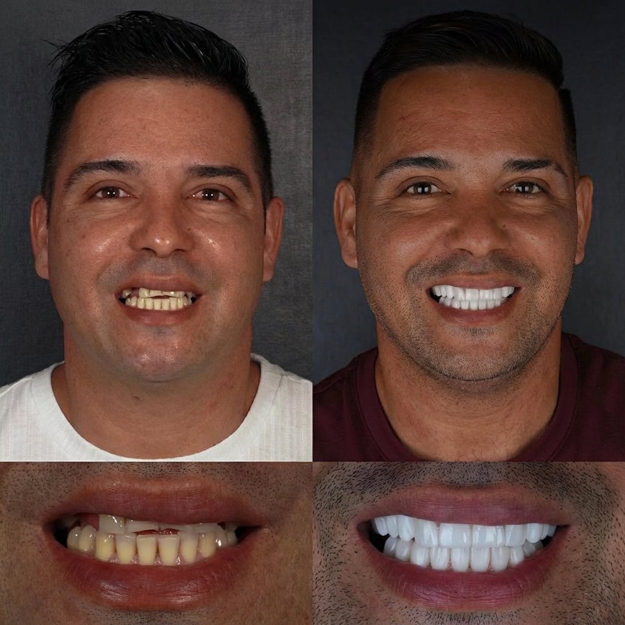 Smile Design with Porcelain Veneers