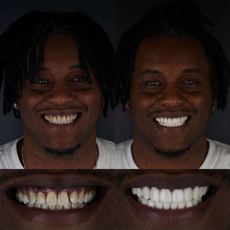 Smile Design with Porcelain Veneers