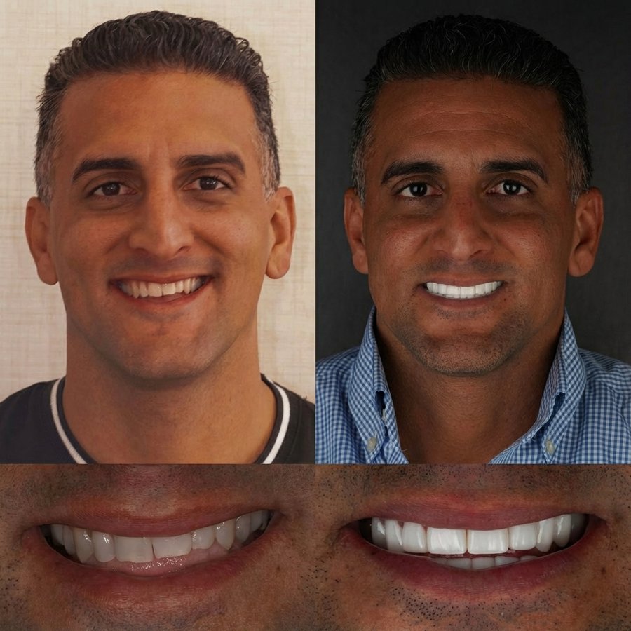 Smile Design with Porcelain Veneers and Dental Implants