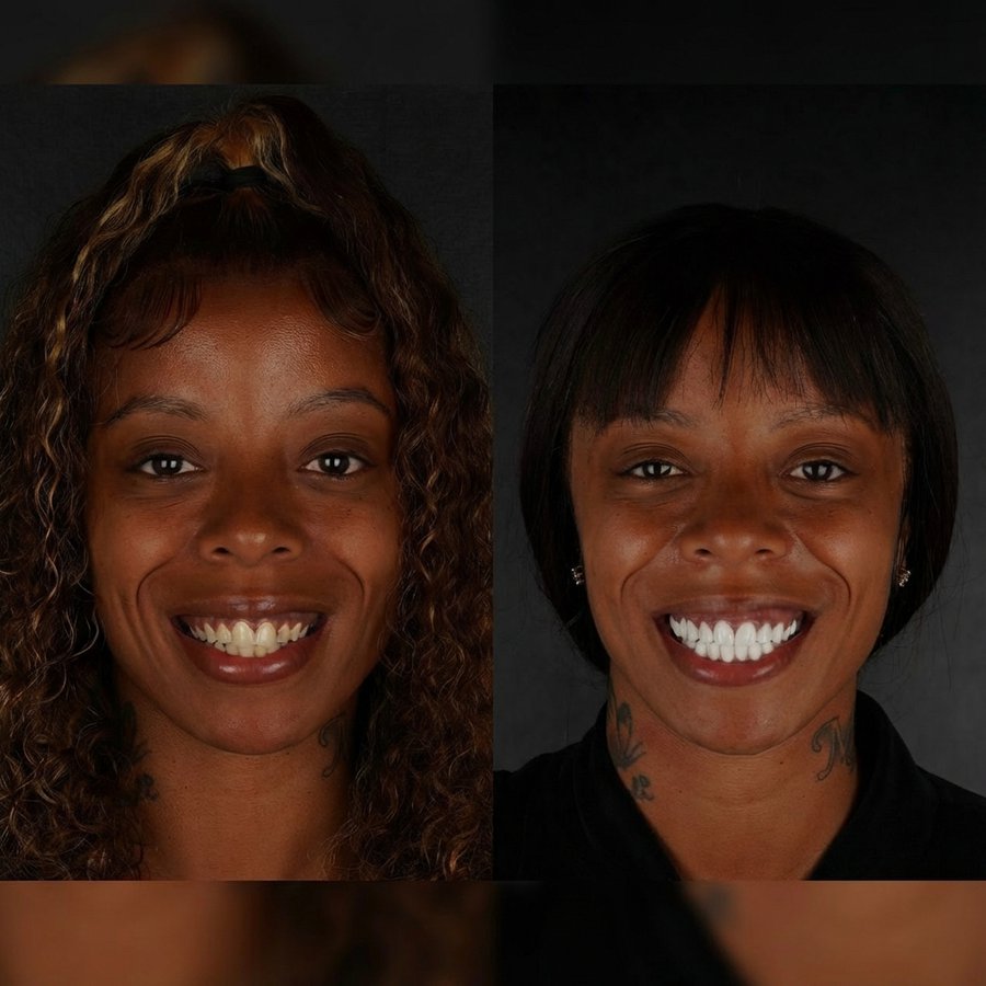 Smile Design with Porcelain Veneers