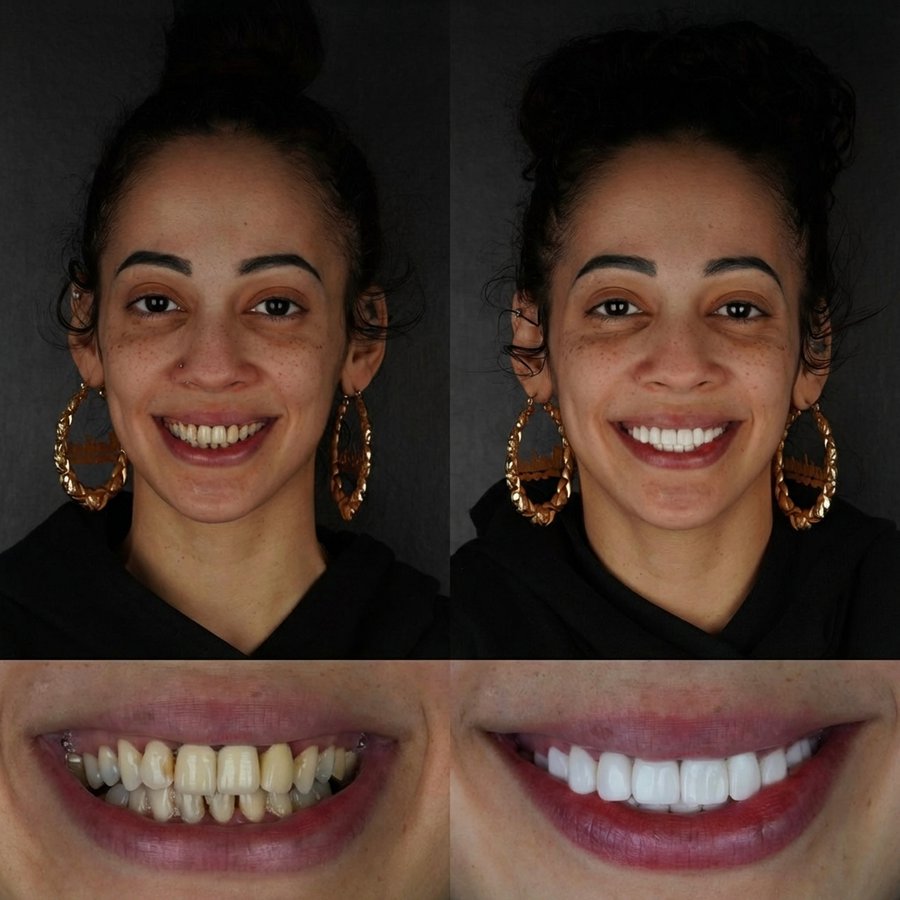 Smile Design with Porcelain Veneers