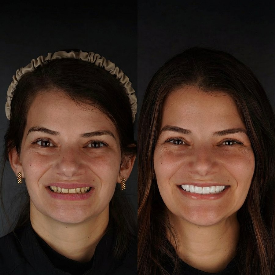 Smile Design with Porcelain Veneers