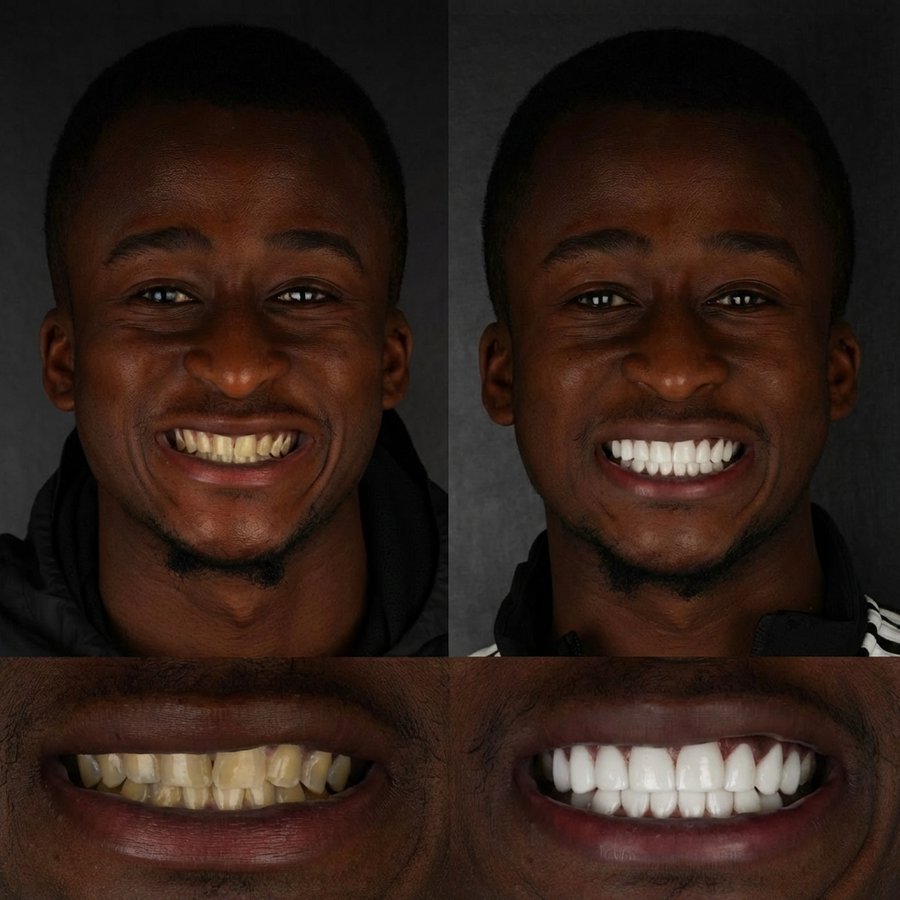 Smile Design with Porcelain Veneers