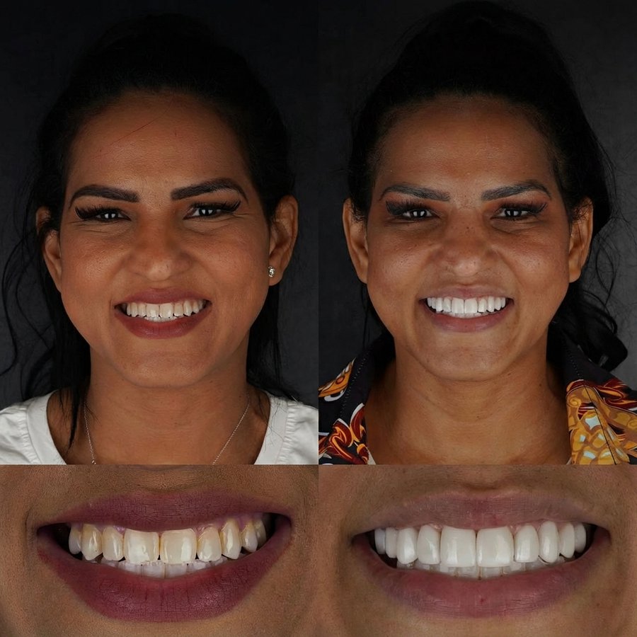 Smile Design with Porcelain Veneers