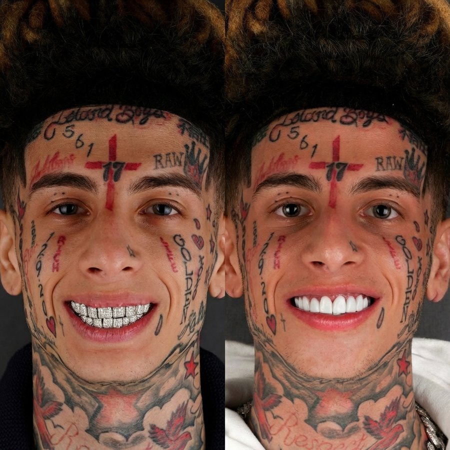 Smile Design with Porcelain Veneers