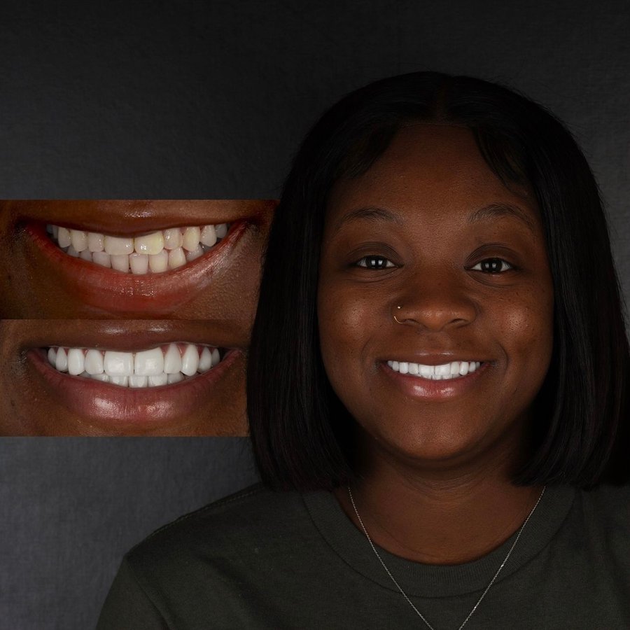 Smile Design with Porcelain Veneers