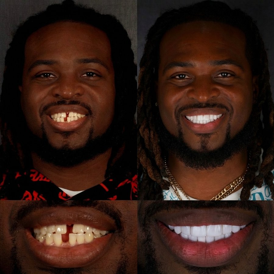 Smile Design with Porcelain Veneers