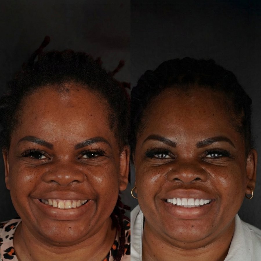 Smile Design with Porcelain Veneers