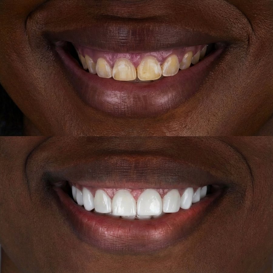 Smile Design with Porcelain Veneers