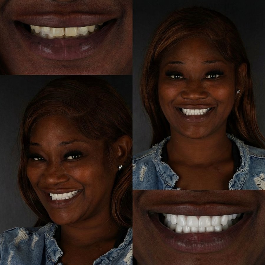 Smile Design with Porcelain Veneers