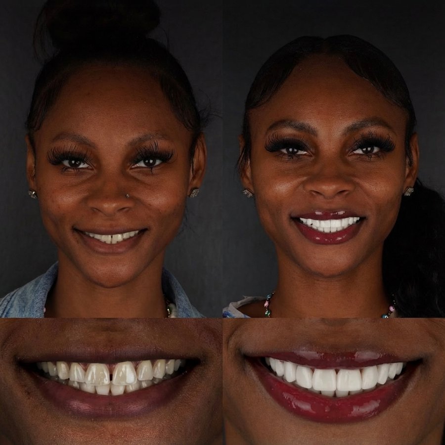 Smile Design with Porcelain Veneers