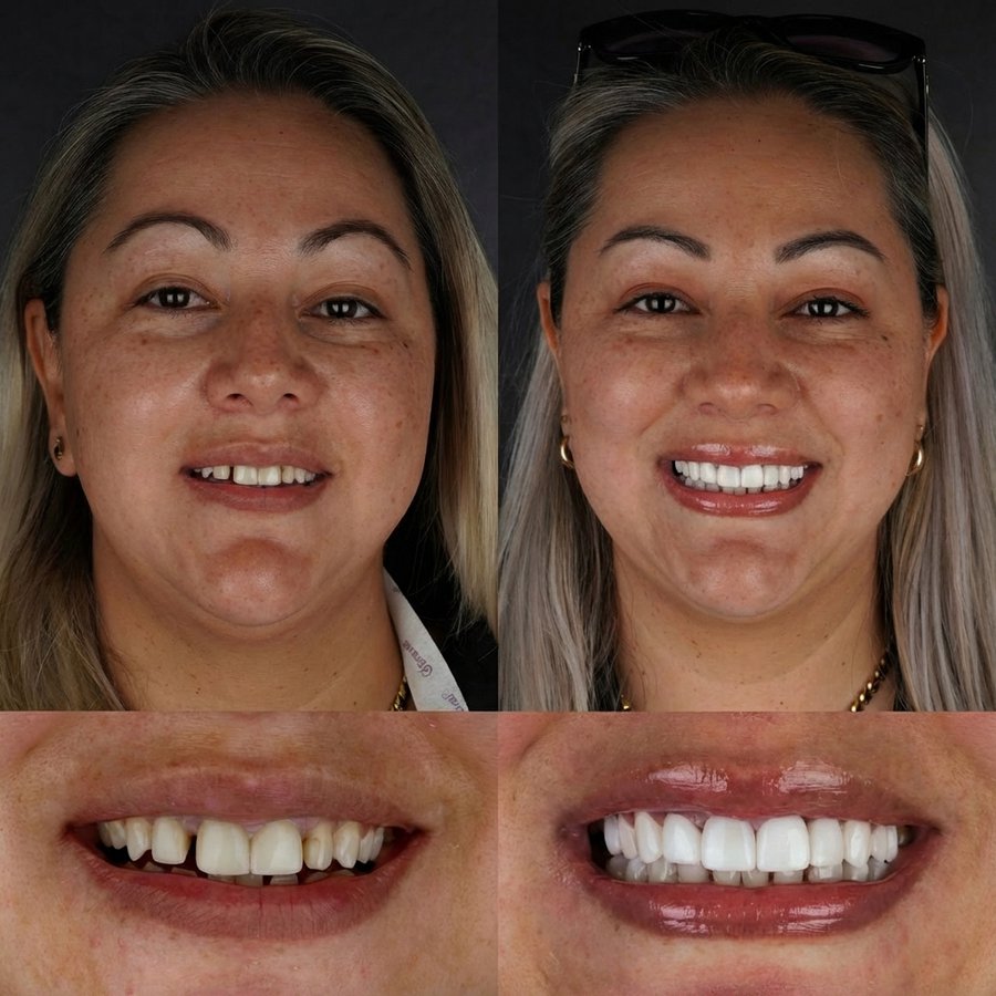 Smile Design with Porcelain Veneers