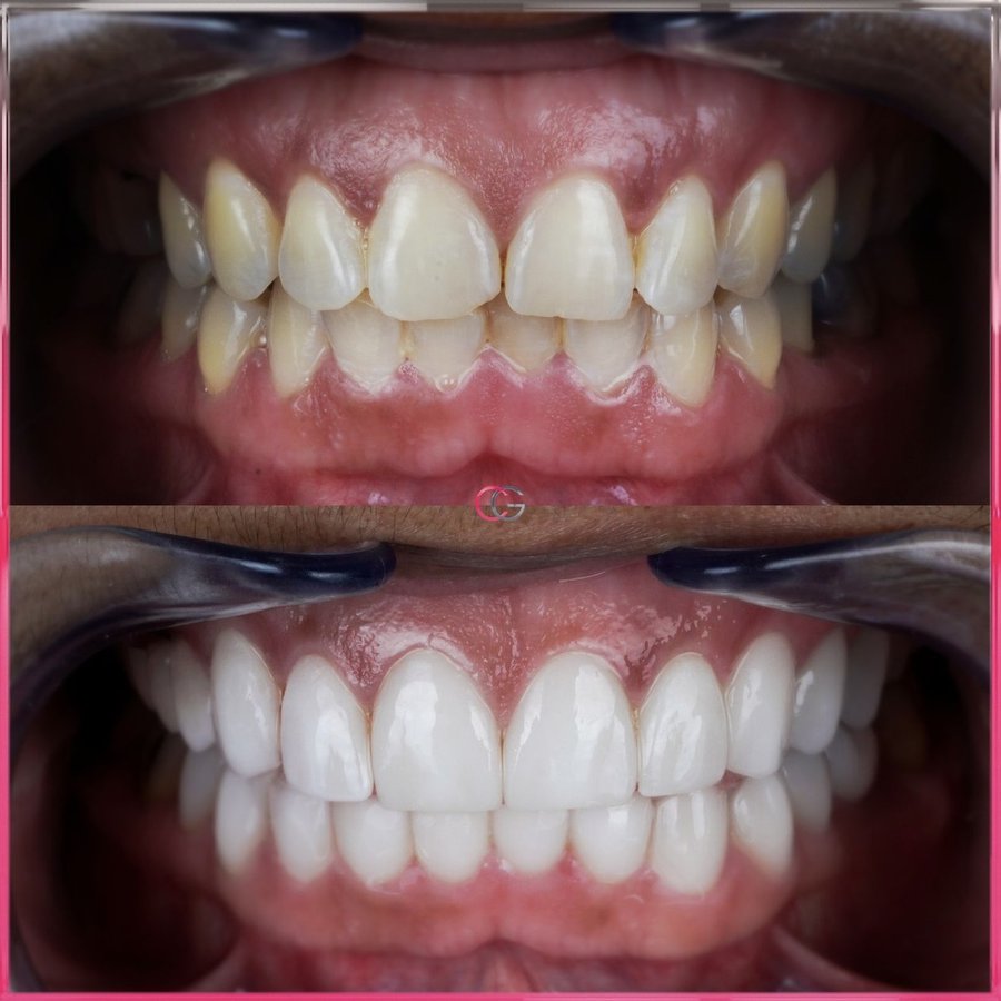 Smile Design with Porcelain Veneers