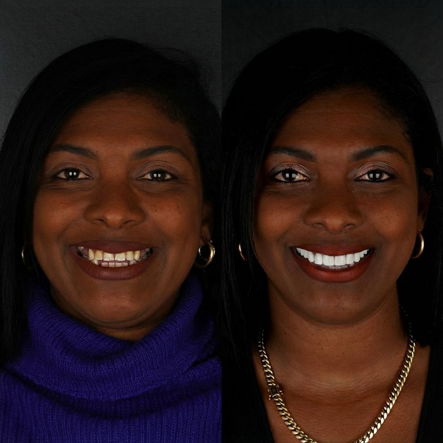 Smile Design with Porcelain Veneers