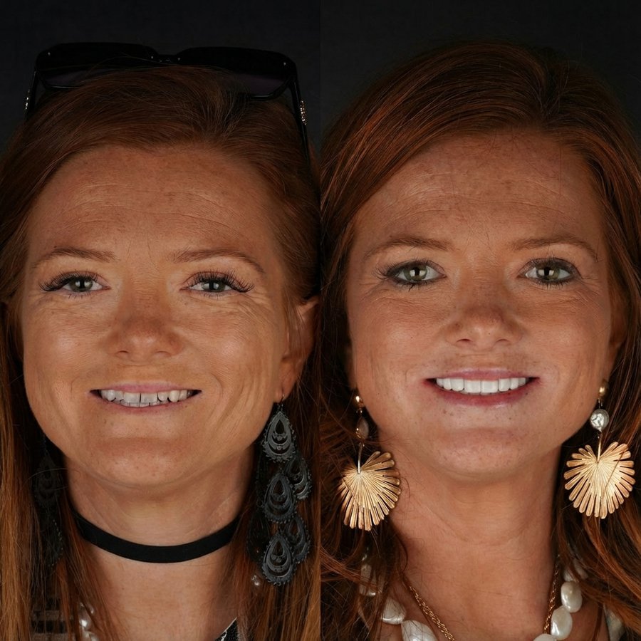 Smile Design with Porcelain Veneers