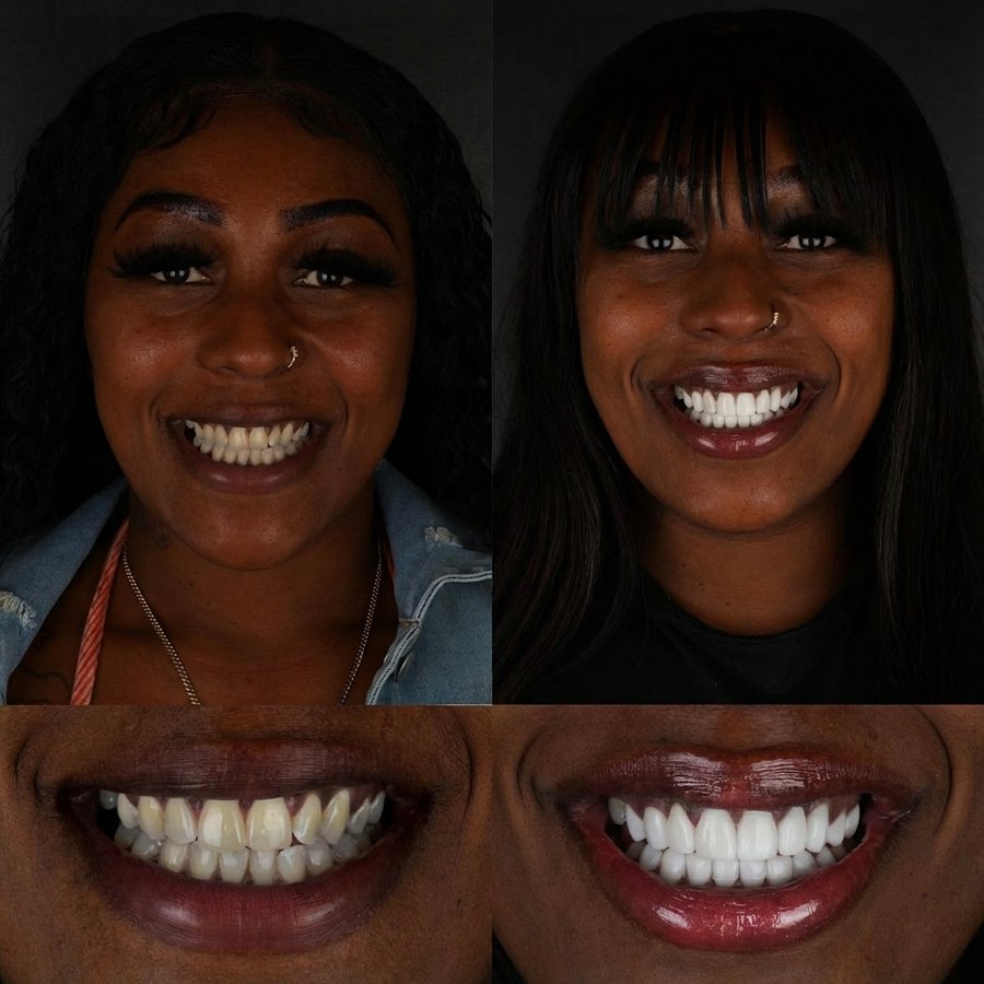 Smile Design with Porcelain Veneers