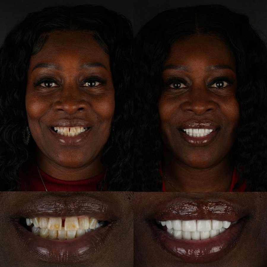 Smile Design with Porcelain Veneers