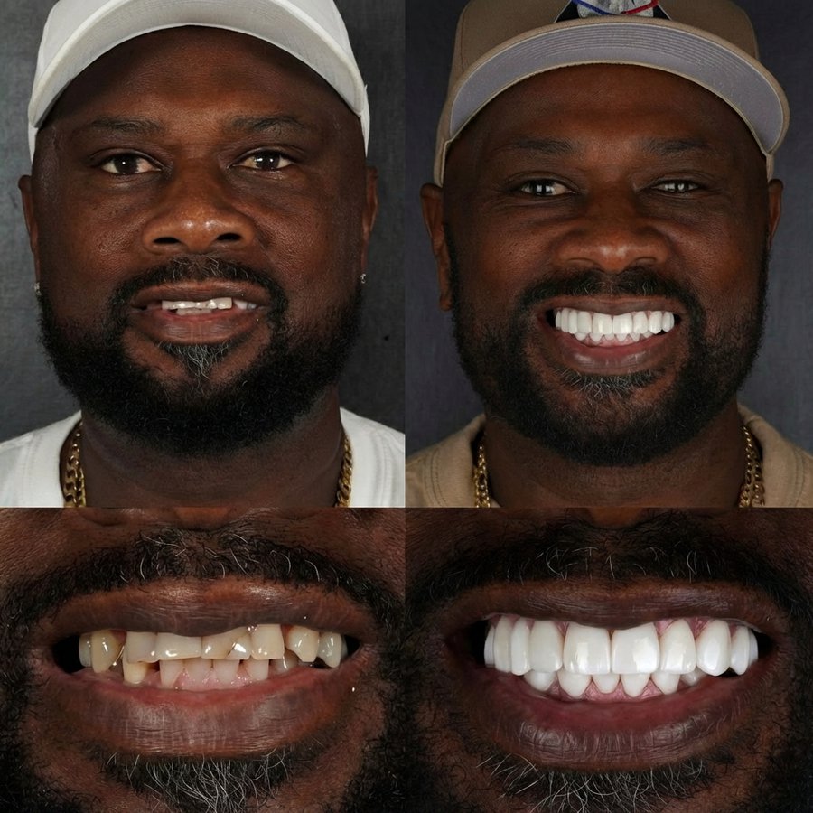 Smile Design with Porcelain Veneers