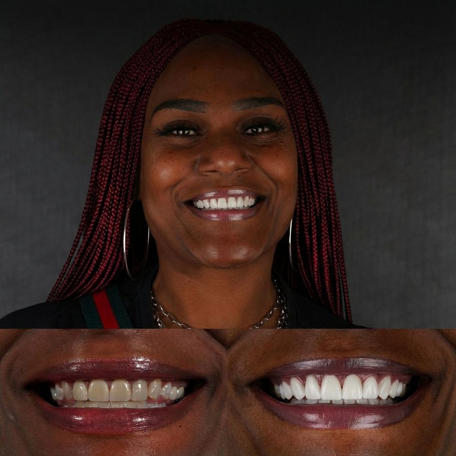 Smile Design with Porcelain Veneers