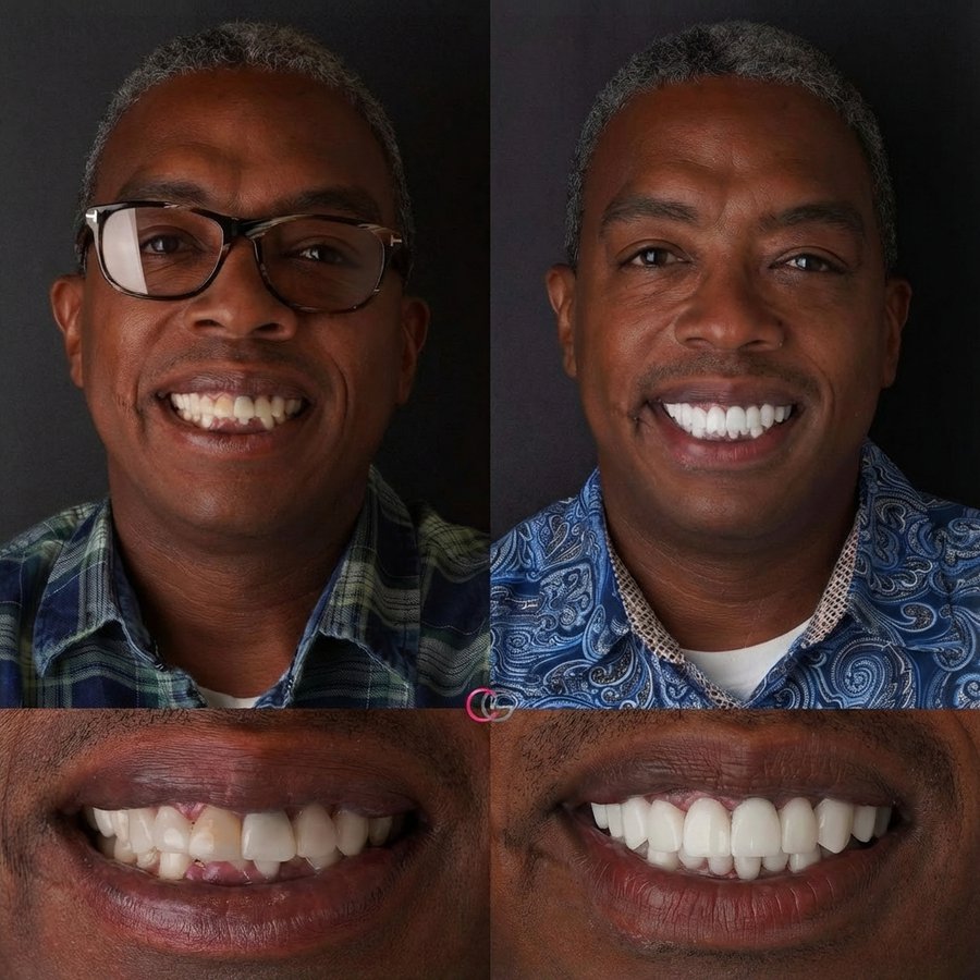 Smile Design with Porcelain Veneers