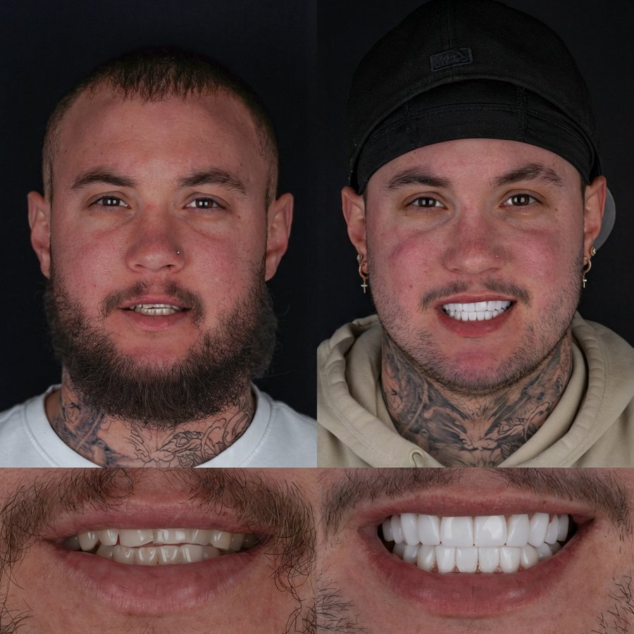 Image for Smile Design with Porcelain Veneers (10 Upper and 10 Lower arch)