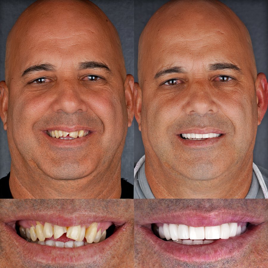 Smile design with Porcelain Veneers