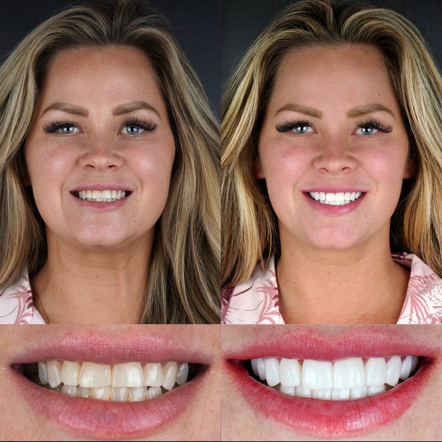 Same Day smile design with porcelain veneers.