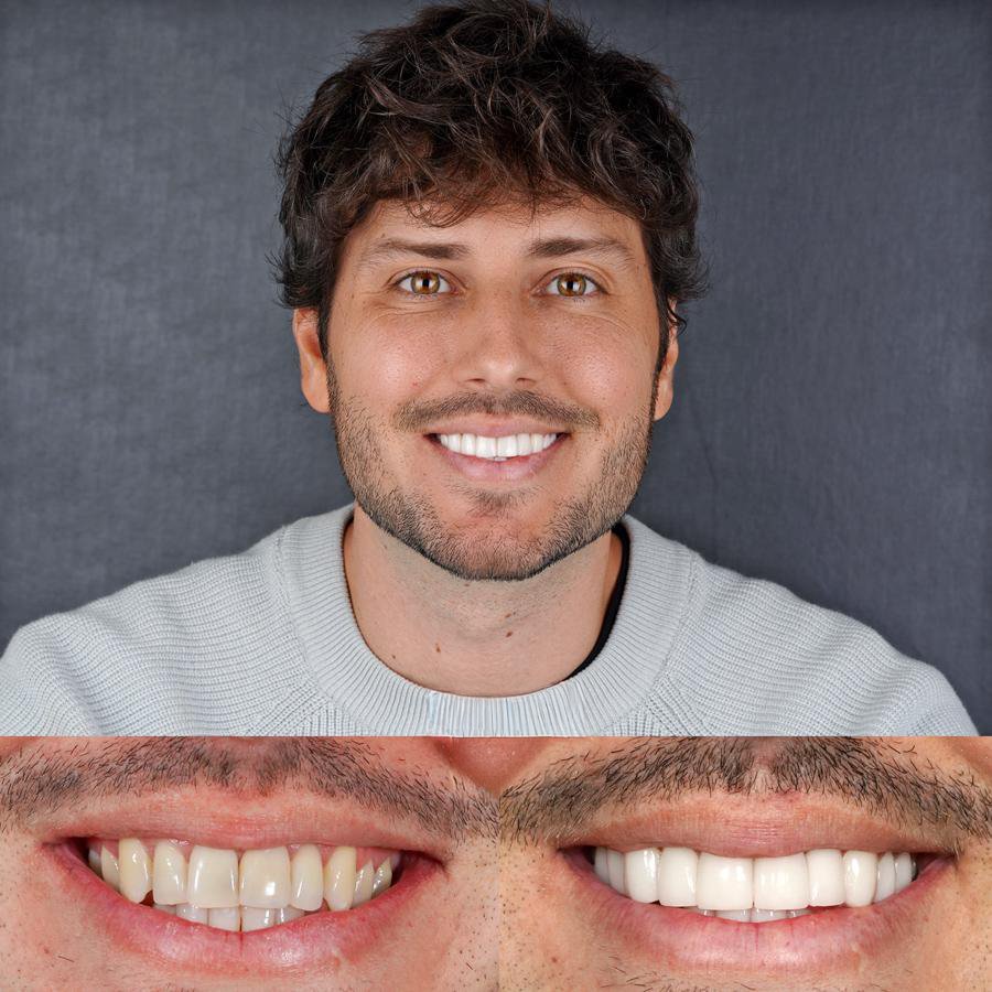 Smile design with Porcelain Veneers