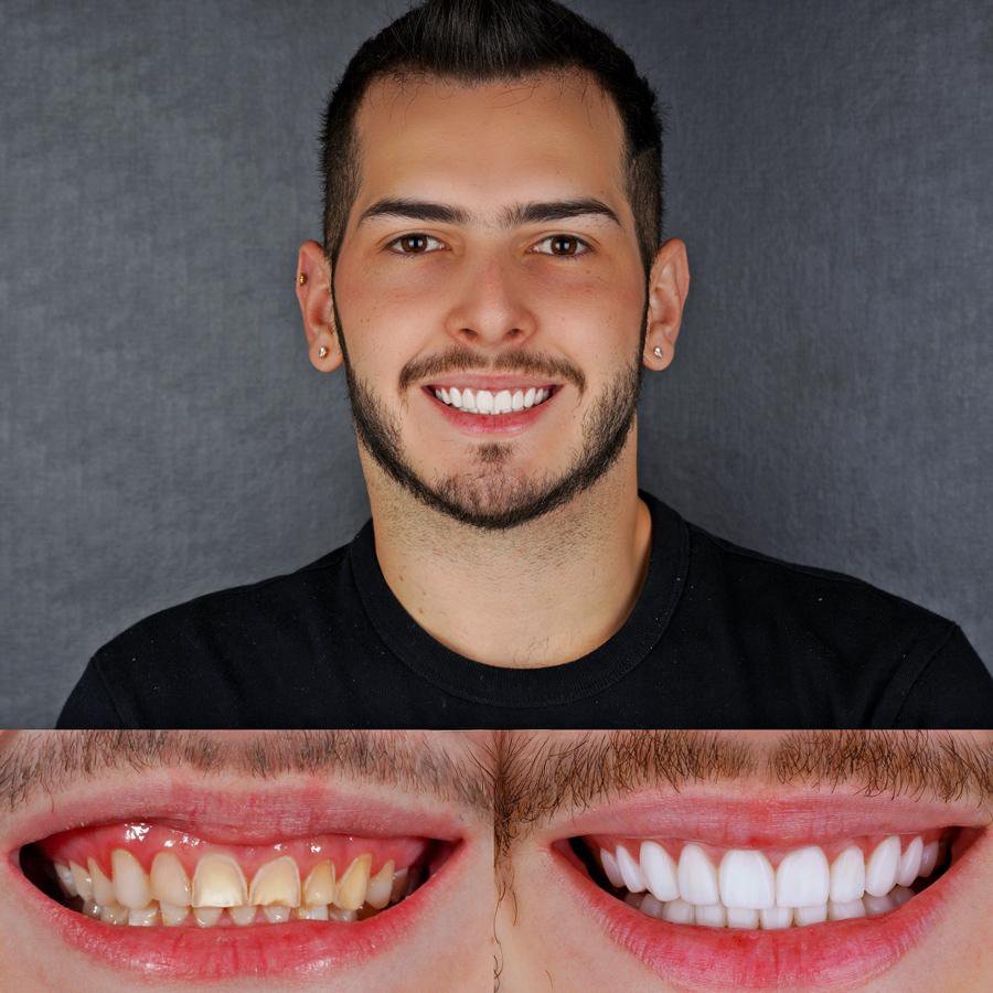 Smile Design with Porcelain Veneers (10 Upper and 10 Lower arch)