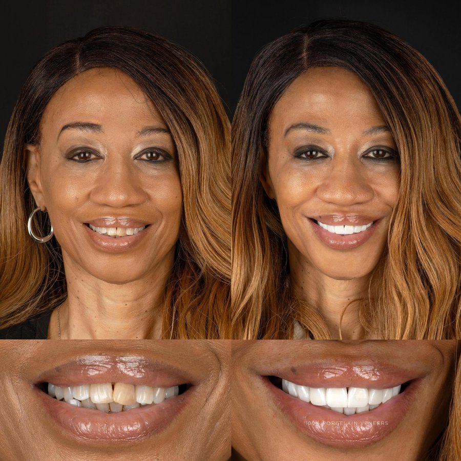 Smile design with porcelain veneers.