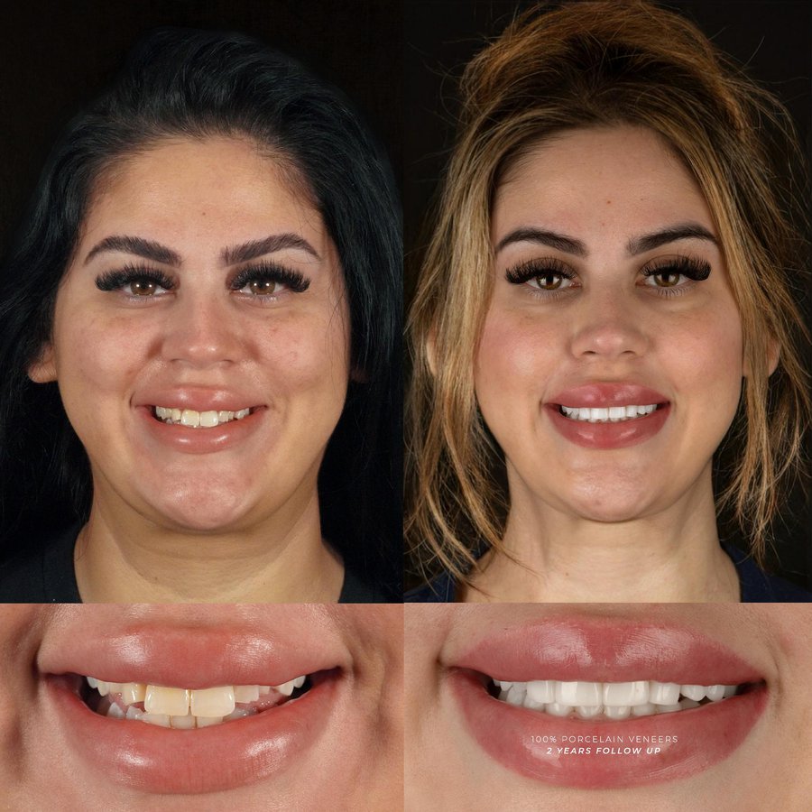 Smile Design with porcelain veneers