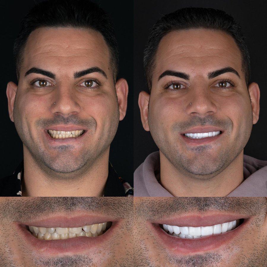 Smile Design with Porcelain Veneers (10 Upper and 10 Lower arch).