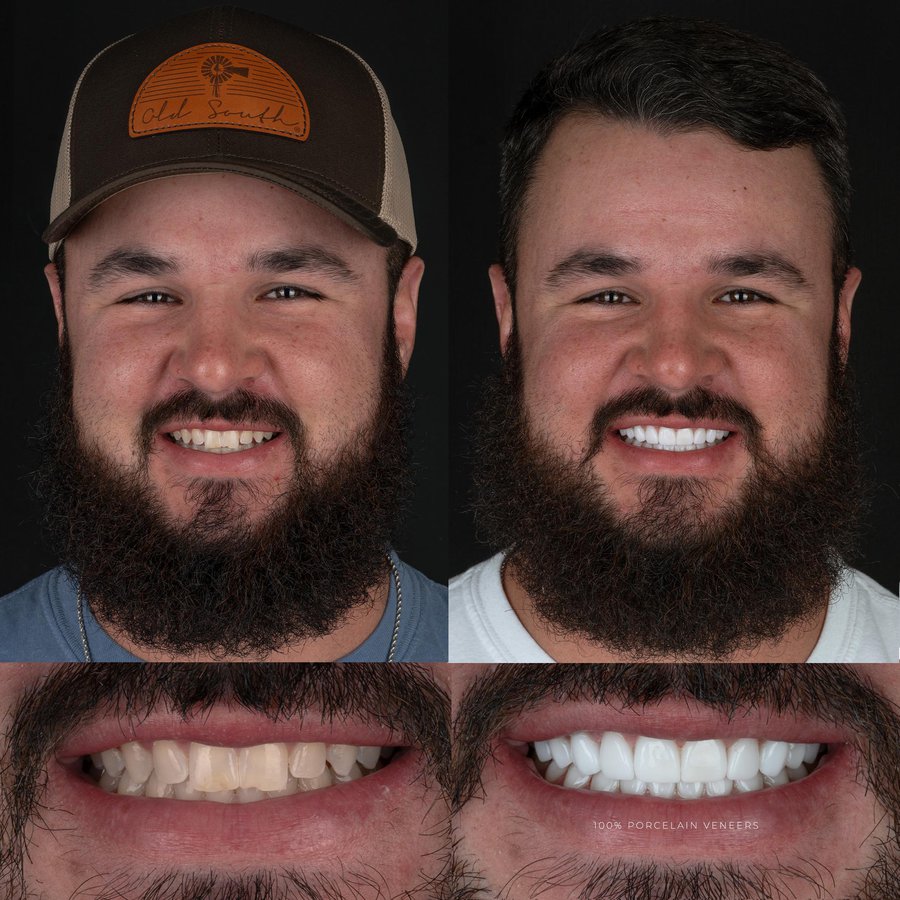 Smile Design with Porcelain Veneers (10 Upper and 10 Lower arch)