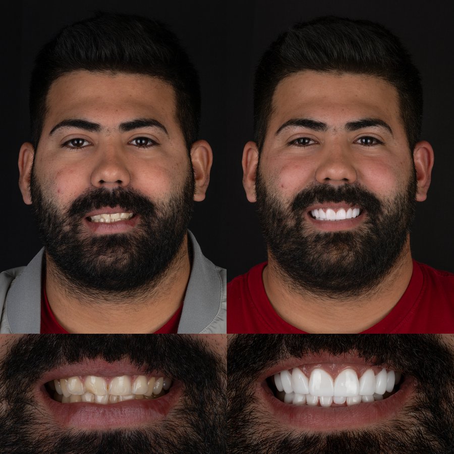 Smile Design with Porcelain Veneers