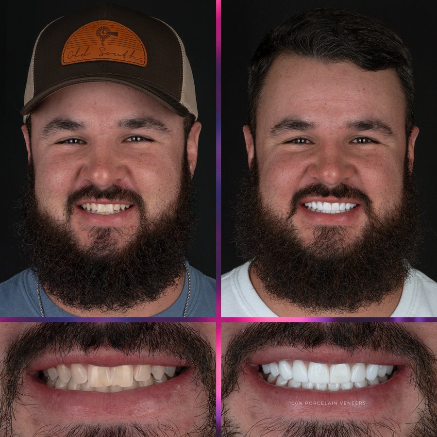 Image for Smile Design with Porcelain Veneers (10 Upper and 10 Lower arch)