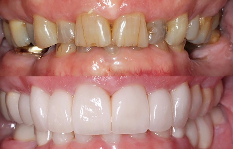 dental restoration before and after