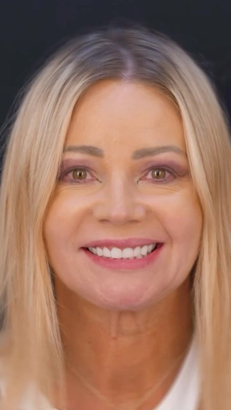 Porcelain Veneers Outcome, Patient Perspective