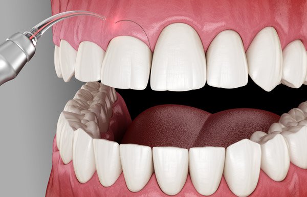 Woman smiling after gummy smile gingivectomy treatment