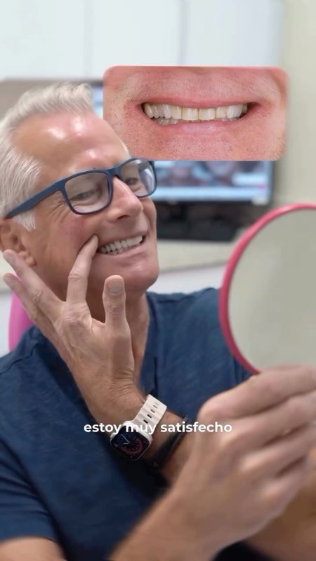 Watch My Porcelain Veneers Story (Miami)