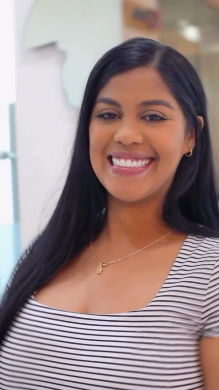 Porcelain Veneers Journey, CG Smile Patient