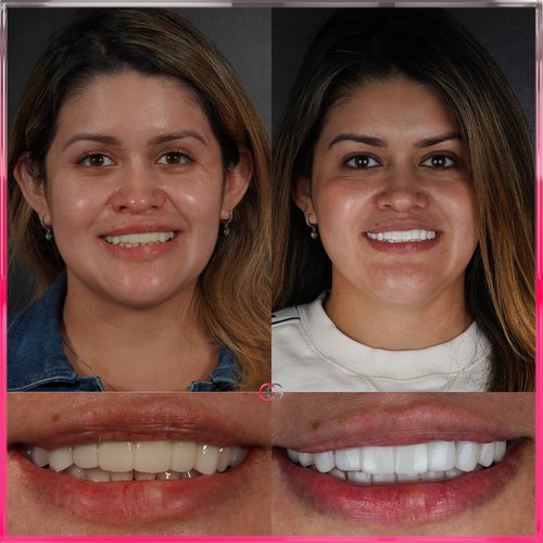 Brand New Smile combining hybrid dentures and p...