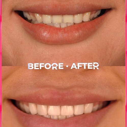 100% Porcelain veneers 🤩 We are giving you the ...