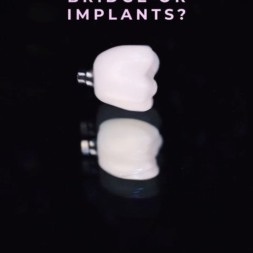 BRIDGE vs. IMPLANT (which one is right for me?)...