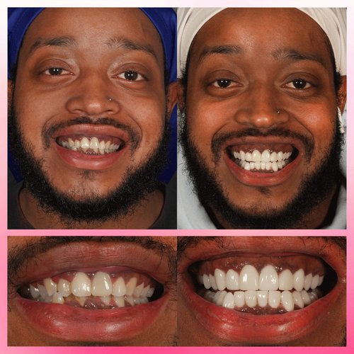 Amazing results of our CG Smile Makeover with c...
